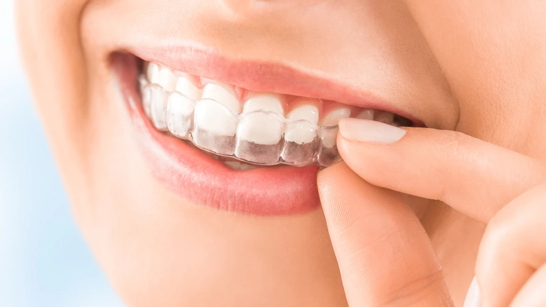 Invisalign